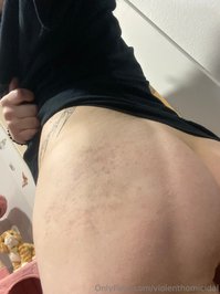 violenthomicidal leak - got my ass blasted here is the bruising <3